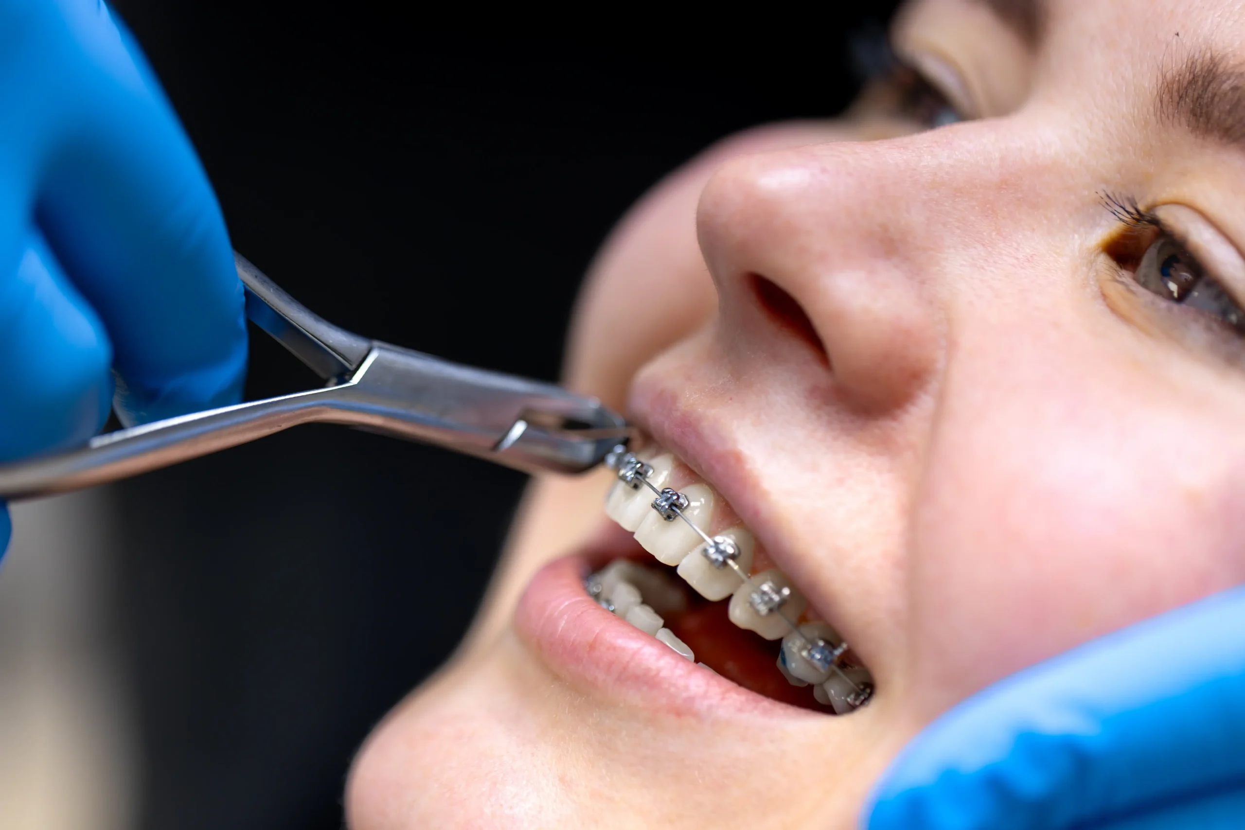 Orthodontie conventionnelle