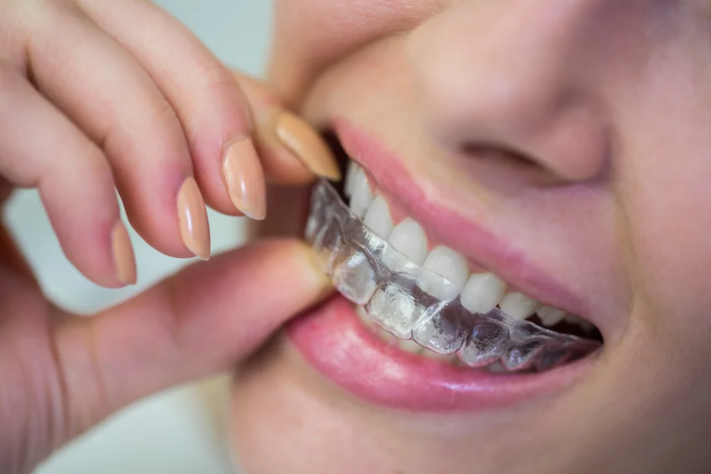 Orthodontie invisible : la discrétion au service de votre sourire