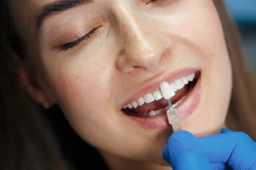 Facettes dentaires : sublimer votre sourire en toute finesse